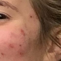 Bellevue Dermatology Clinic - Left Cheek Before Picture