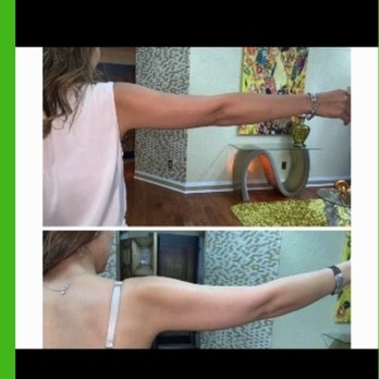 Pandora Skin Studio - Before / After ( only 1 time) HIFU treatment on my arms - Skin Care Near Me - Columbia, Maryland Pandora Skin Studio - Before / After ( only 1 time) HIFU treatment on my arms - Skin Care Near Me - Columbia, Maryland