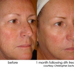 De La Belle Wellness & Spa - Dermasweep facial before and after