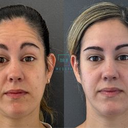 Dr B Medspa - Botox treatment