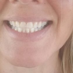 Calimesa Dental - David You, DDS - Dr. You did an AMAZING job fixing my tooth! It looks so natural. Rebecca and you are always fun during a Dental visit. #Happysmiles