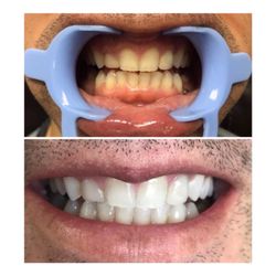 DaVinci Laser Teeth Whitening - One session Amazing results!