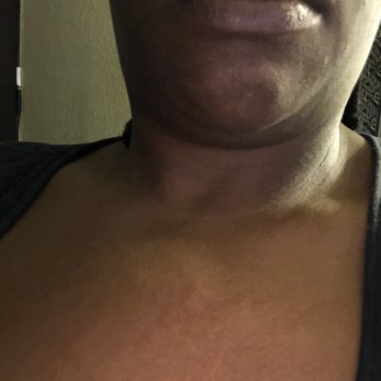 DoubleTree by Hilton - Rash on my chest - Hotels Near Me - Orlando, Florida DoubleTree by Hilton - Rash on my chest - Hotels Near Me - Orlando, Florida