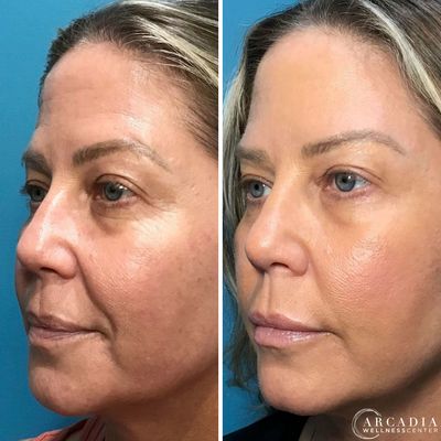 Natural results with Wrinkle Relaxer and Fillers - Amazing natural results with wrinkle relaxer and dermal filler treatments to enhance and rejuvenate your appearance. We offer complimentary consultations to help you reach your goals.