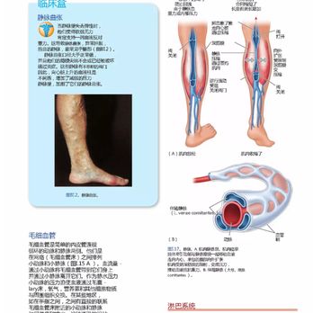 Ginkgo TCM Centre - Principle of varicose veins - Acupuncture Near Me - Spring, Texas Ginkgo TCM Centre - Principle of varicose veins - Acupuncture Near Me - Spring, Texas