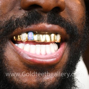 Gold Teeth Gallery - Jewelry Near Me - Oakland, California Gold Teeth Gallery - Jewelry Near Me - Oakland, California