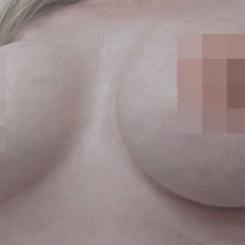 Tri Valley Plastic Surgery - AFTER - Medical Spas Near Me - Dublin, California