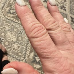 Lumpy nails and bleeding cuticles Lumpy nails and bleeding cuticles