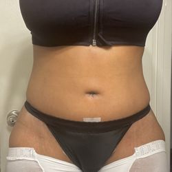 Sinno Center for Plastic Surgery - 2weeks post op
