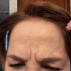 Between brows after "50" units of watered down Botox from Revive in Carmel Valley!