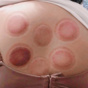 BodyCentre Fullerton - After cupping - Massage Near Me - Fullerton, California BodyCentre Fullerton - After cupping - Massage Near Me - Fullerton, California