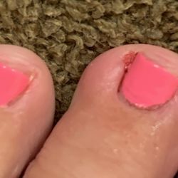 Angel Nails - My poor toe after leaving Angel's Nails