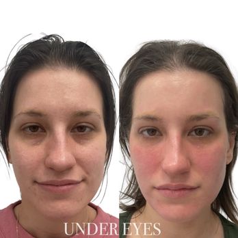 ND Advance MedSpa - Permanent Makeup Near Me - Lancaster, Pennsylvania ND Advance MedSpa - Permanent Makeup Near Me - Lancaster, Pennsylvania