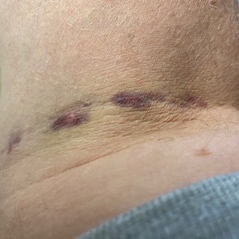 Quest Diagnostics - next day - blood extraction aftermath - Laboratory Testing Near Me - Brockton, Massachusetts