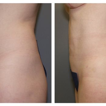 DAVinci Plastic Surgery - This patient benefitted from a Hernia Repair and Liposuction of the Abdomen, Flanks, Hips and Thighs. Call today to book your consult! - Cosmetic Surgeons Near Me - Washington, DC, District of Columbia