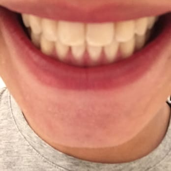 Passamano Orthodontics - After - Orthodontists Near Me - Irvine, California