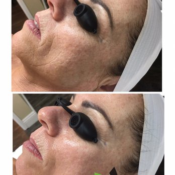 Naulin Aesthetics - Serum Infusion Facial - Skin Care Near Me - Thousand Oaks, California Naulin Aesthetics - Serum Infusion Facial - Skin Care Near Me - Thousand Oaks, California