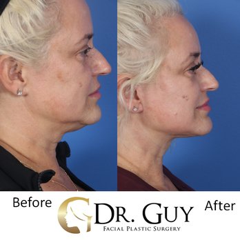 Dr Guy Facial Plastic Surgery - Deep plane facelift - Plastic Surgeons Near Me - Conroe, Texas