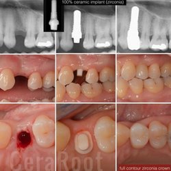 CeraRoot Zirconia Implants - Holistic Dentistry - This patient had a premolar extracted few yrs back. There was enough bone to make the surgery flapless.