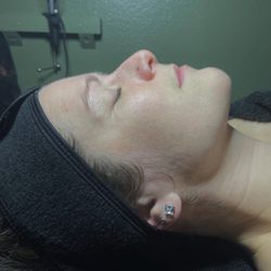 Emerson Esthetics - Dermaplane facial before