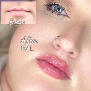 Kiss Me Vegas - I absolutely hated my lips and lack of a top lip before. Merika built up my cupids bow and really gave a beautiful shape to my top lip. - Skin Care Near Me