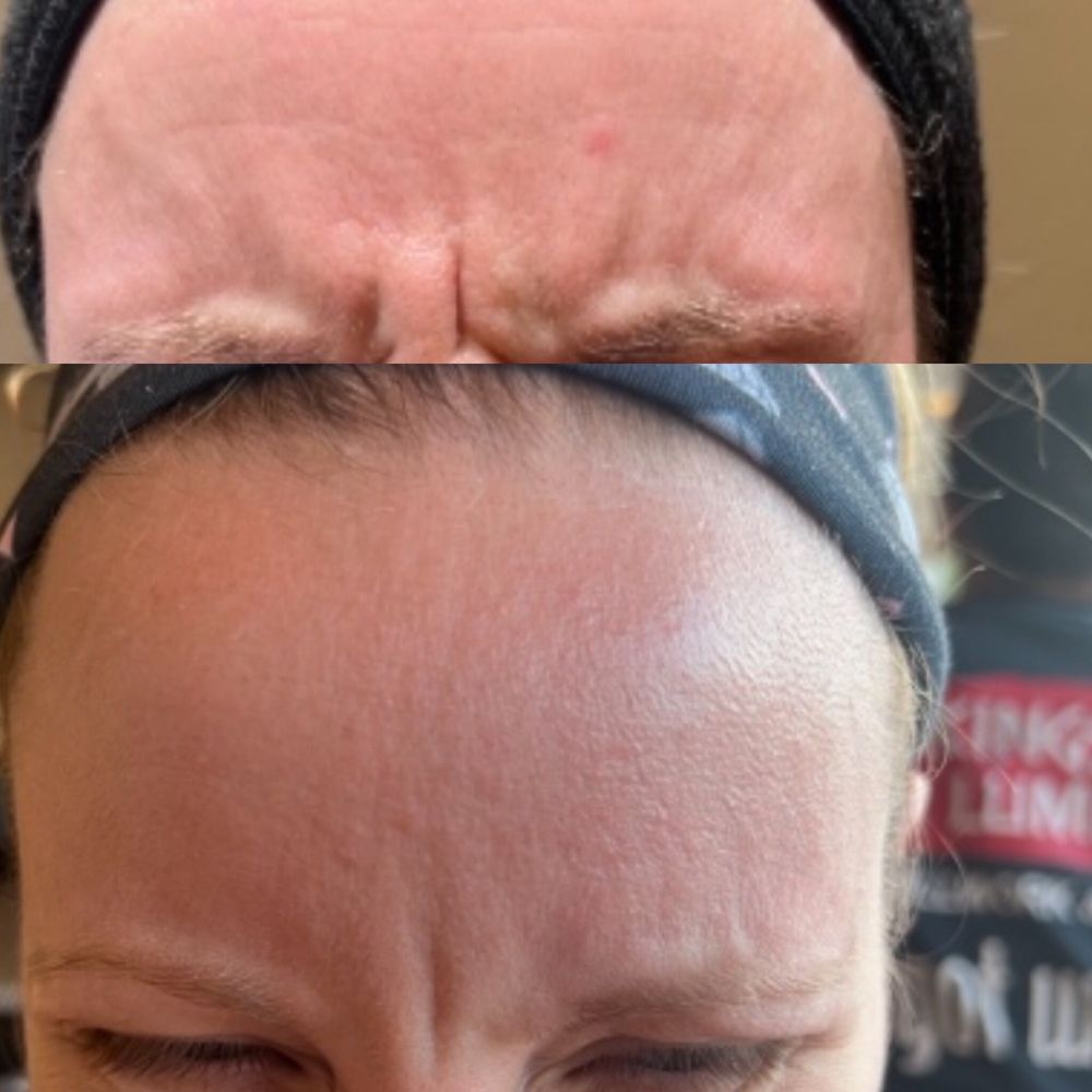 Envy Injectables & Skincare - Top photo is prior to botox done by Jenni  Bottom is 4 months later results of the botox that Jenni injected!!! Crazy difference - Medical Spas Near Me - Westminster, Colorado