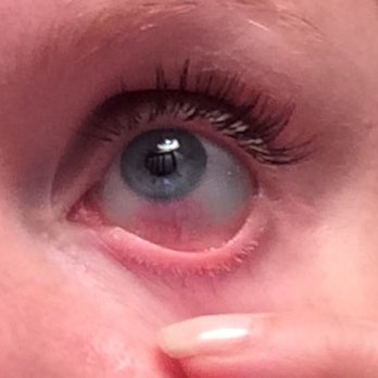 Maison de Lash - Irritated red eye after eyelash extensions at Maison de Lash. - Eyelash Service Near Me - New York, New York
