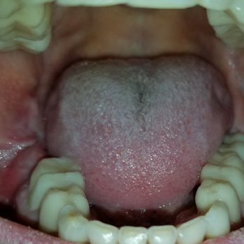 Sharp Susan B - Gum was sewn to inside of cheek. - Periodontists Near Me - Tucson, Arizona Sharp Susan B - Gum was sewn to inside of cheek. - Periodontists Near Me - Tucson, Arizona