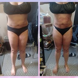 Total Image Master Body Sculpting - Same Day Results