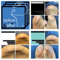 Electrolysis Beauty Lounge - Before and After