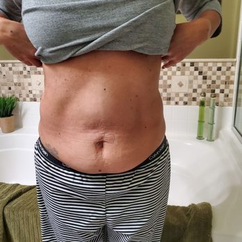 Daniel G Kolder, MD - Pacifica Center for Plastic Surgery - Before Tummy tuck - Cosmetic Surgeons Near Me - Camarillo, California