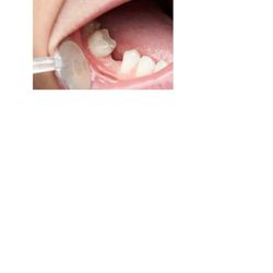 My Family Dental Grosse Pointe - A missing tooth can affect the shape of your face and  general health. Call today for your FREE consultation to learn about dental implants!