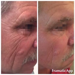 Regenesis Skin Studio - Reduction in lines and wrinkles using the Venus Viva , and Rezenerate
