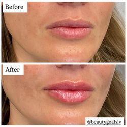 Beauty Goals LV - Lip fillers
