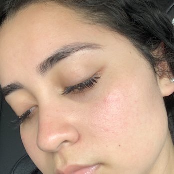So Vain Beauty Aesthetics - After facial - Skin Care Near Me - Hialeah, Florida