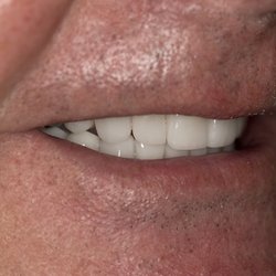 Borowski Cosmetic Dentistry - After side view 20 veneers.