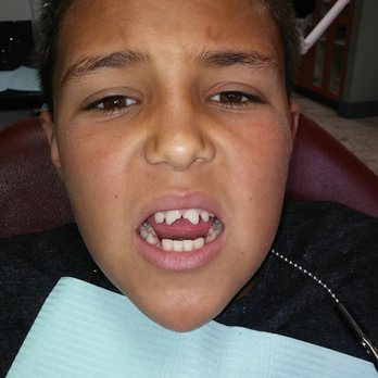 Apple Dental - This is my sons before!! - Cosmetic Dentists Near Me - Merced, California Apple Dental - This is my sons before!! - Cosmetic Dentists Near Me - Merced, California