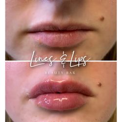 Lines And Lips - 0.5ml Juvederm Ultra