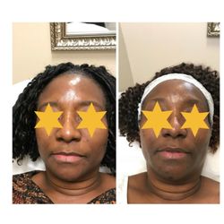Vonetta Cosmetics - left (after) 2/6/18-right (before) 10/14/17. approximtely 3 months and one week for a more even skintone.
