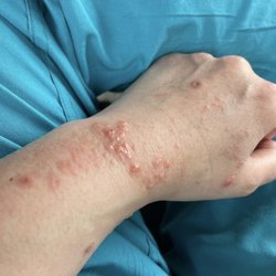 Prime Pharmacy - Covid vaccine triggered immune response