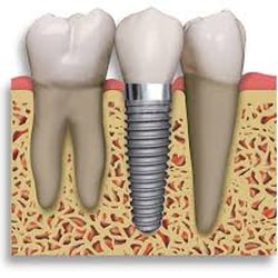 Robert V Massa, DMD - SINGLE TOOTH MISSING Benefits of an all-ceramic crown on implant: When both the tooth and root are damaged, the best permane...