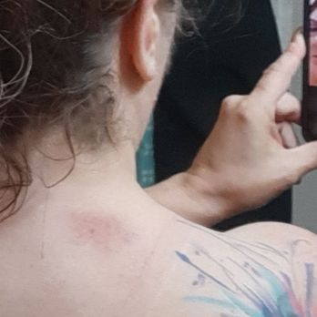 Sunshine Massage Therapy - Bruising on my neck. - Massage Near Me - Spring Hill, Florida