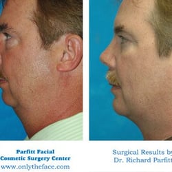 Parfitt Facial Cosmetic Surgery Center - Chin Implant Appleton WI by Dr. Richard Parfitt