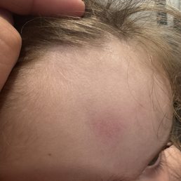 My daughter Forehead My daughter Forehead