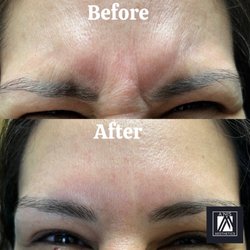 A'nis Aesthetics - Botox Before and After
