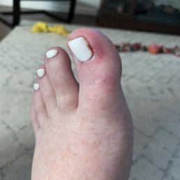 Infected toenail