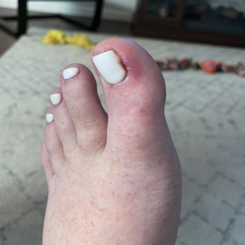 Utopia Spa - Infected toenail - Nail Salons Near Me - Sicklerville, New Jersey