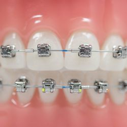 Hwang Orthodontics - Enjoy a more gentle, comfortable treatment with smaller brackets and less force on your teeth using the Damon System!