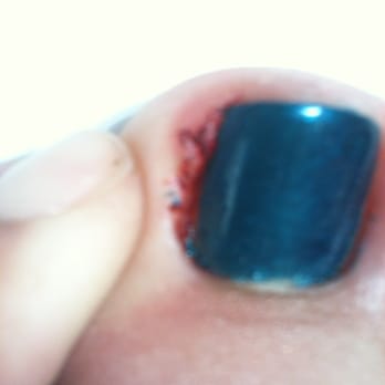 Elegant's Nails - This is after I got home and cleaned it with alcohol...coldn't get the blood off! - Nail Salons Near Me - Bonita, California Elegant's Nails - This is after I got home and cleaned it with alcohol...coldn't get the blood off! - Nail Salons Near Me - Bonita, California