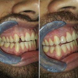 Luis Sanchez, DMD - Composite Veneers